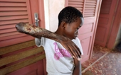 Bùng phát nạn dịch loét ‘ăn thịt người’ lây lan ở Australia
