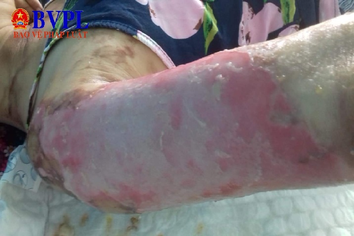 Tài xế khiến hành khách bị bỏng nặng, giám đốc nhà xe   chỗ chết thì chui làm gì