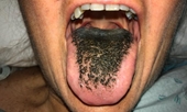 Lý giải hiện tượng lưỡi ‘mọc lông đen’