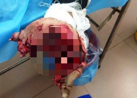 Nam thanh niên bị nát bàn tay bởi dùng điện thoại trong khi sạc