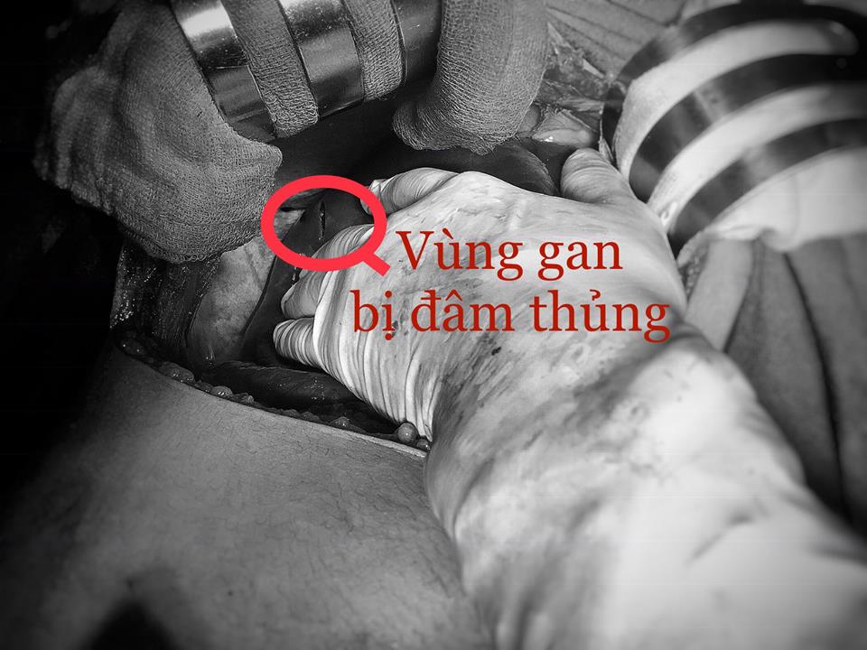Báo động đỏ cứu sống bệnh nhân thủng gan, tim trong ngày 27 Tết