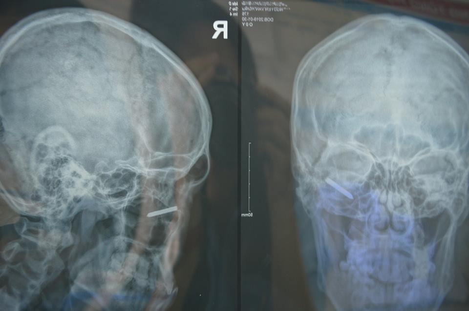 Sửa nhà ngày cận Tết suýt mất một con mắt