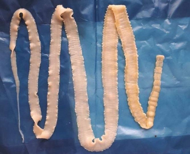 NÓNG Bộ Y tế thông tin chính thức về sán lợn