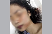 Thông tin về vụ cô gái 18 tuổi bị rạch mặt dã man, phải khâu 60 mũi