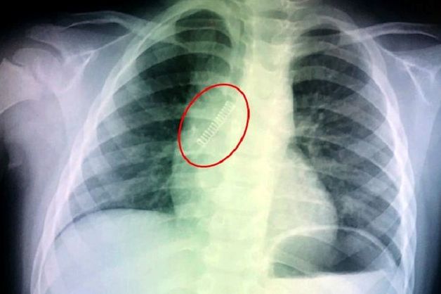 Bé trai nhập viện vì một lý do không ngờ