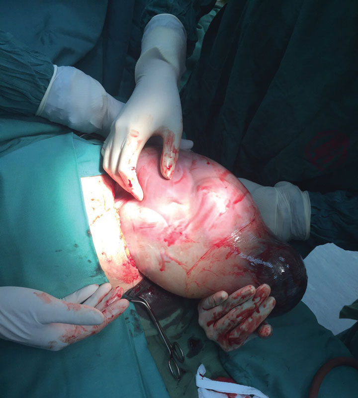 Em bé ở Hải Dương chào đời vẫn nằm nguyên trong túi ối