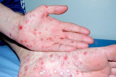 Bé trai 13 tuổi mắc bệnh giang mai do quan hệ đồng giới