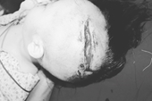 Bé 2 tuổi bị chó cắn rách 15cm trên đầu, làm hở xương sọ