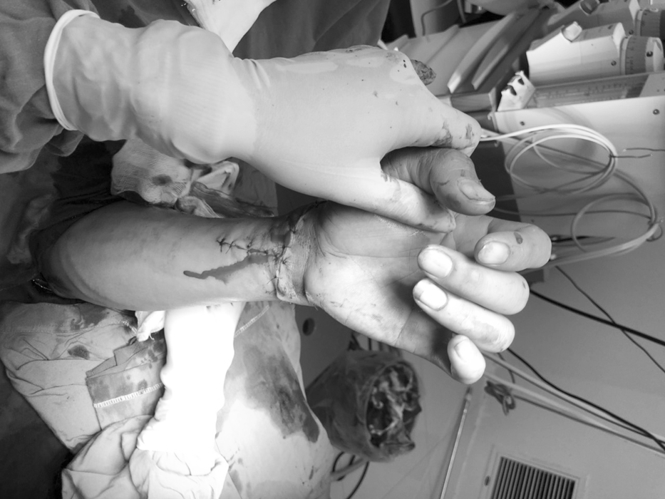 Nối thành công bàn tay bị chém đứt lìa