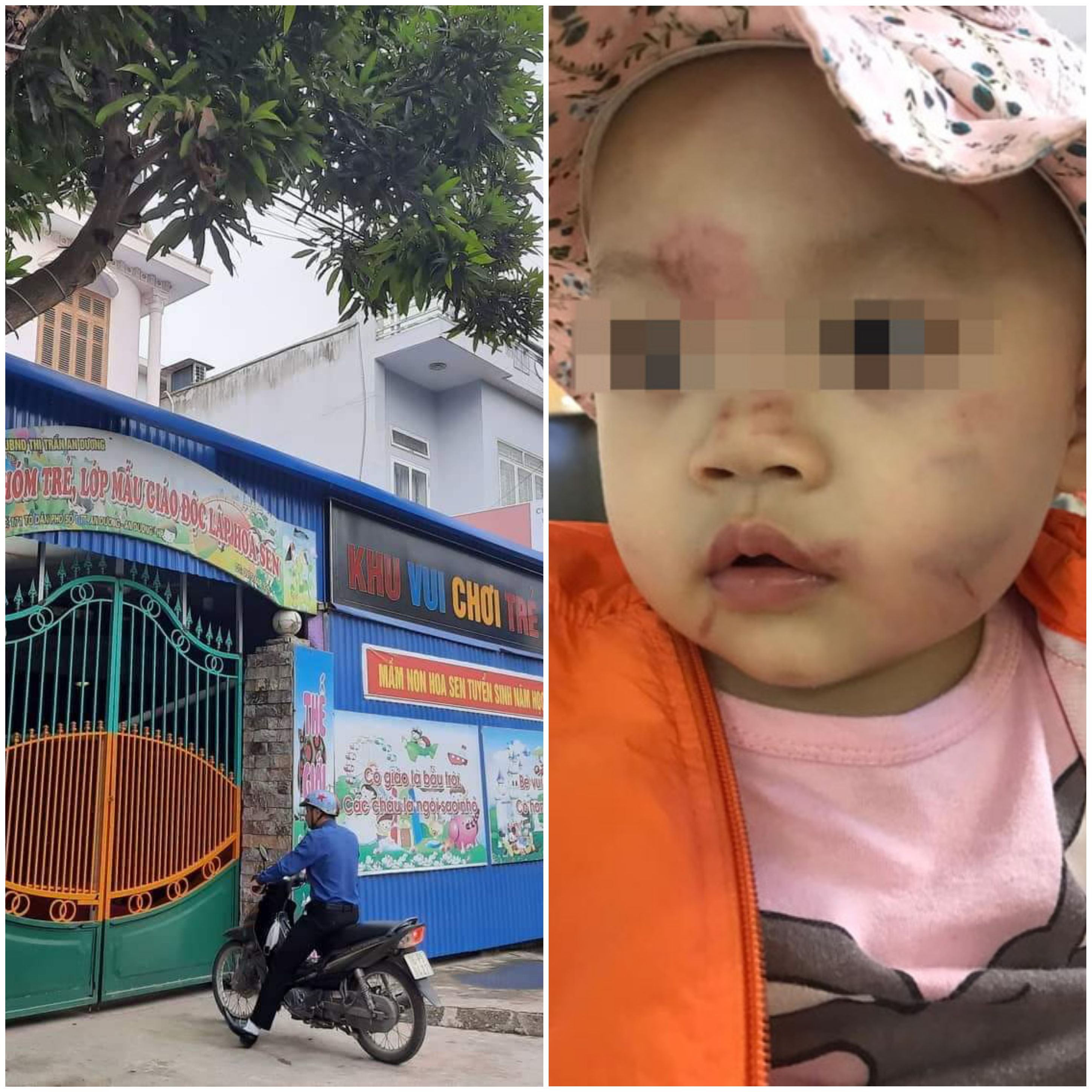 Buổi đầu đi học, cháu bé 14 tháng tuổi bị bầm tím mặt