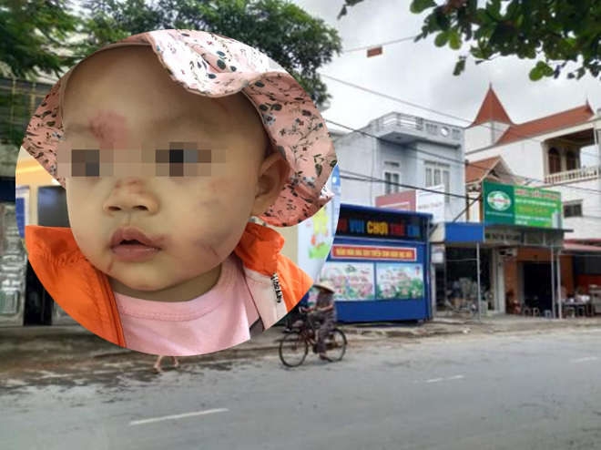 Nguyên nhân bất ngờ vụ bé 14 tháng tuổi bị bầm tím mặt