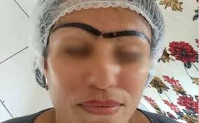 Xăm chân mày làm đẹp, một cụ bà nhập viện cấp cứu