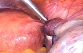 Phẫu thuật nội soi u nang buồng trứng xoắn cho bệnh nhân có thai