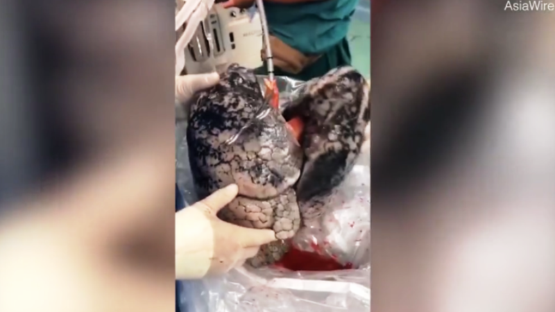 Video gây sốc lá phổi đen như than của người đàn ông nghiện thuốc lá 30 năm