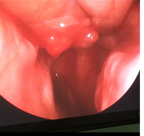 Hàn mạch máu cứu sống bệnh nhân bị chảy máu mũi ồ ạt