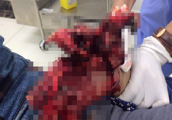 Hai thiếu niên nát bàn tay do chế tạo pháo nổ học trên mạng