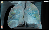 Video 3D tái hiện COVID-19 tấn công phổi người bệnh