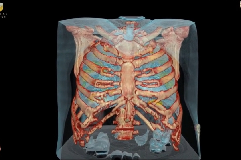 Virus SARS-CoV-2 tàn phá lá phổi của con người như thế nào