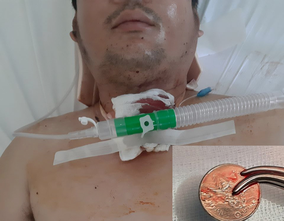 Phẫu thuật cấp cứu kịp thời, cứu sống nạn nhân mắc đồng xu trong khí quản