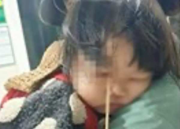 Bé gái 3 tuổi bị que kem chọc xuyên hốc mắt vì vừa ăn vừa chạy nhảy