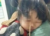 Bé gái 3 tuổi bị que kem chọc xuyên hốc mắt vì vừa ăn vừa chạy nhảy