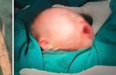 Sinh thường tại gia, bé sơ sinh bị dao rơi rách mặt