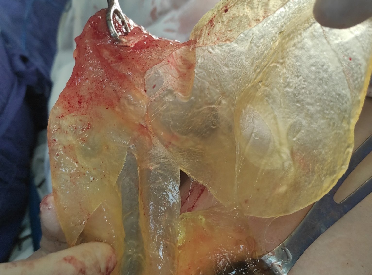 Vỡ túi silicon nâng ngực, người phụ nữ chết lặng phát hiện khối u