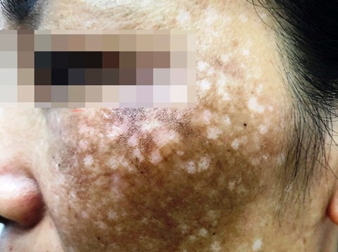 Chữa rám má hết 500 triệu đồng, người phụ nữ “cầu cứu” bác sĩ