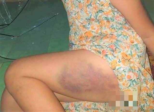 Cô giáo đánh một học sinh lớp 3 bầm tím đùi…vì làm bài sơ sài