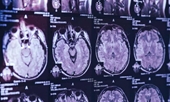 Căn bệnh não bí ẩn khiến giới chức Canada đau đầu truy tìm nguyên nhân