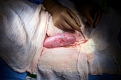 Ghép thử nghiệm thành công thận lợn cho một bệnh nhân