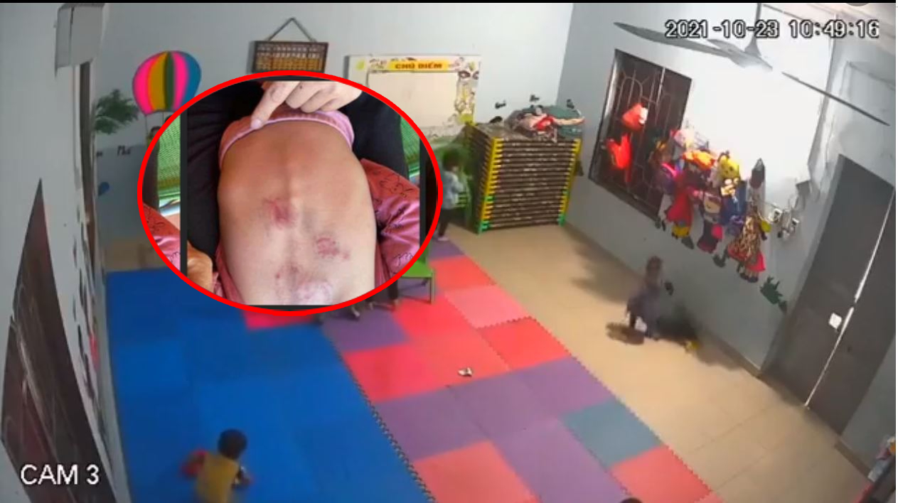 Đình chỉ cơ sở mầm non để cháu bé 22 tháng tuổi bị đánh tím người