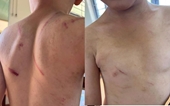 Cháu bé 9 tuổi nghi bị cha và bà nội đánh bầm dập khắp người ở Đắk Lắk