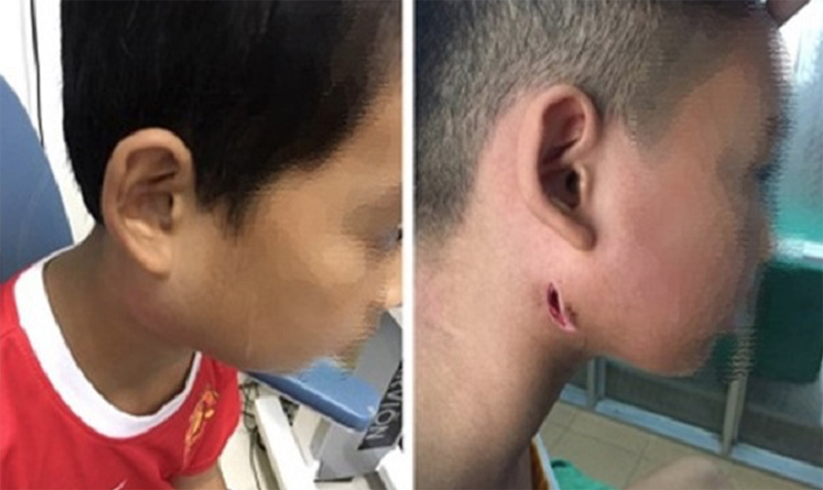 Một bé trai ở Thanh Hóa đã tử vong do nhiễm vi khuẩn Whitmore