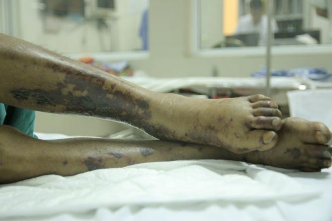 Người bán thịt lợn nhiễm liên cầu khuẩn lợn