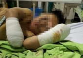 Bé trai 8 tuổi bị thương nặng, mất hai bàn tay sau tiếng nổ lớn