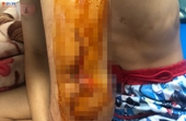 Một sinh lớp 10 ở Đắk Lắk bị đâm trọng thương 2 tay