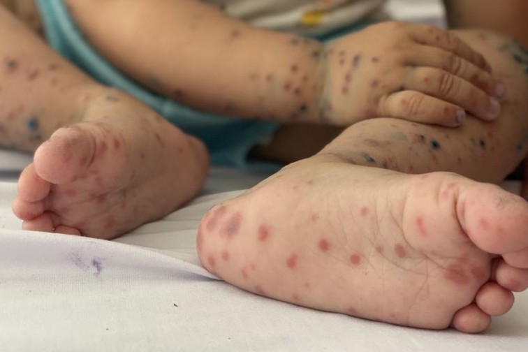 Ca mắc bệnh tay chân miệng tăng nhanh, xuất hiện vi rút EV71 gây bệnh nặng