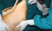 Sở Y tế TP HCM thông tin trường hợp tai biến sau phẫu thuật thẩm mỹ hút mỡ