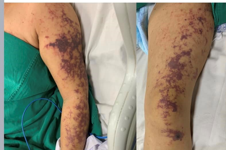 Người phụ nữ ở Hà Nội bị viêm màng não sau khi ăn lòng lợn