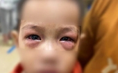 Dịch đau mắt đỏ xuất hiện, nhiều trẻ gặp biến chứng nặng