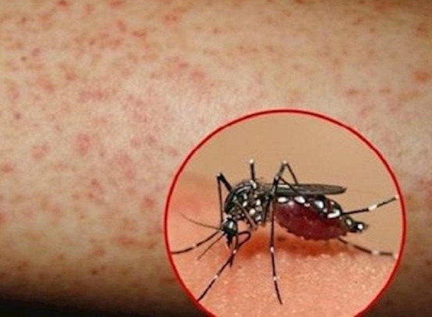 Thêm một trẻ 13 tuổi ở Đắk Lắk tử vong do mắc sốt xuất huyết