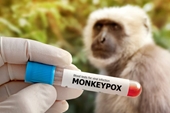 Long An phát hiện một trường hợp mắc bệnh đậu mùa khỉ
