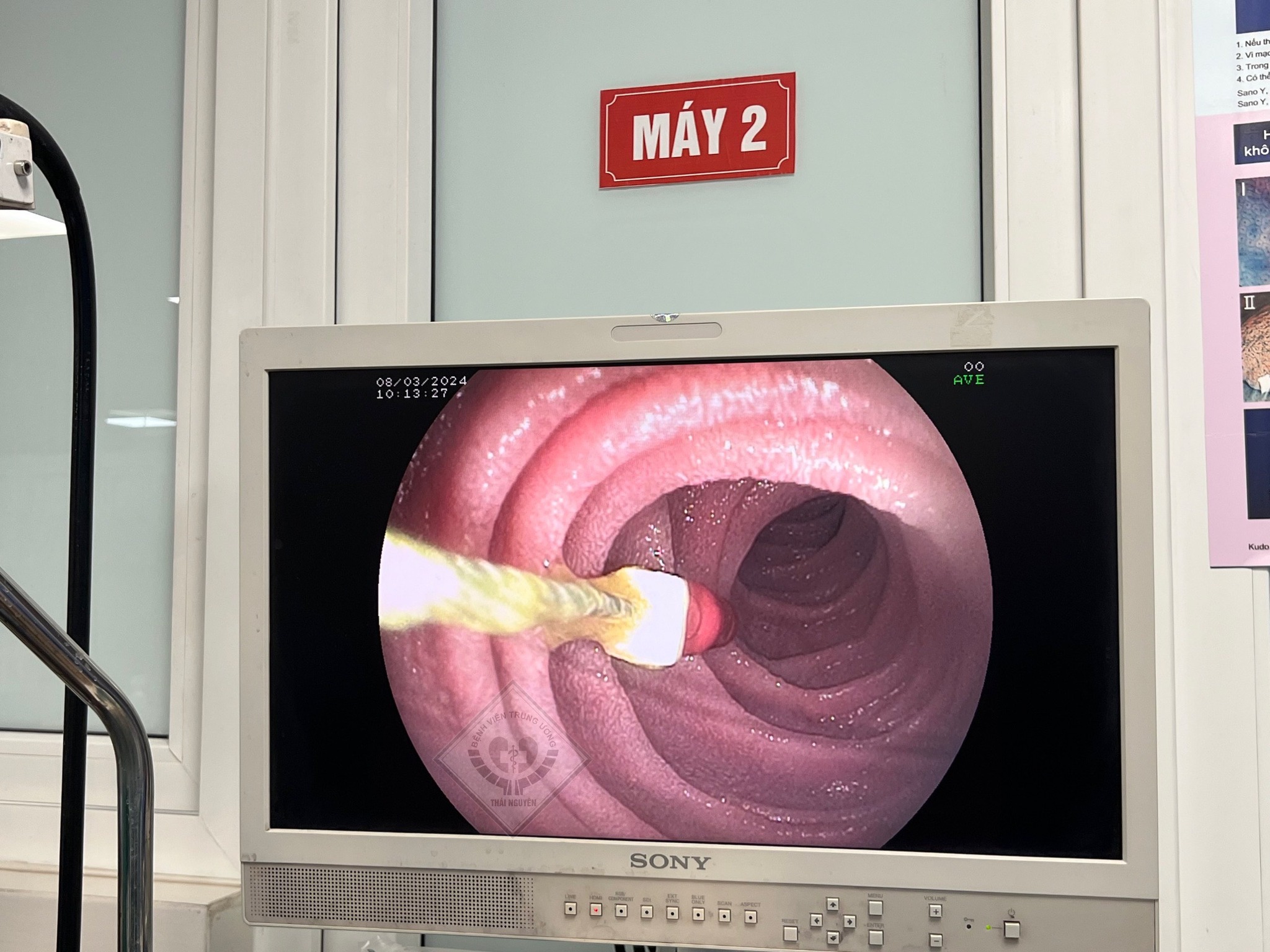 Trẻ 8 tuổi đi khám răng bị kim diệt tủy rơi vào đường tiêu hóa