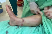 Nối bàn chân bị đứt lìa cho một người phụ nữ ở Đắk Lắk