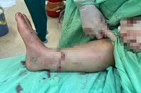 Nối bàn chân bị đứt lìa cho một người phụ nữ ở Đắk Lắk