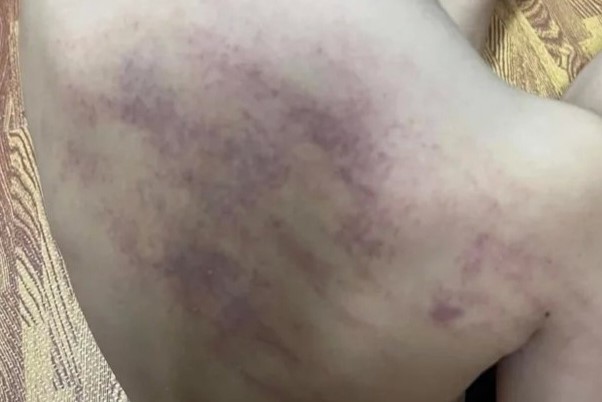 Kết quả xác minh vụ bé 5 tuổi bị bầm tím ở lưng