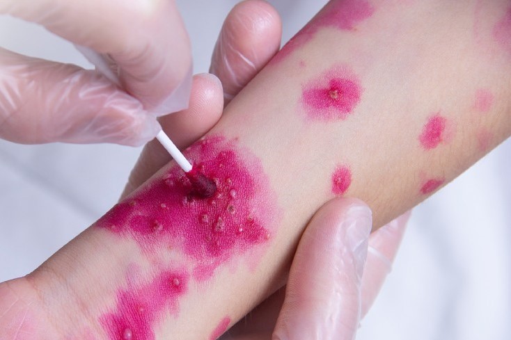 Nhiều trẻ sơ sinh lây thuỷ đậu từ mẹ