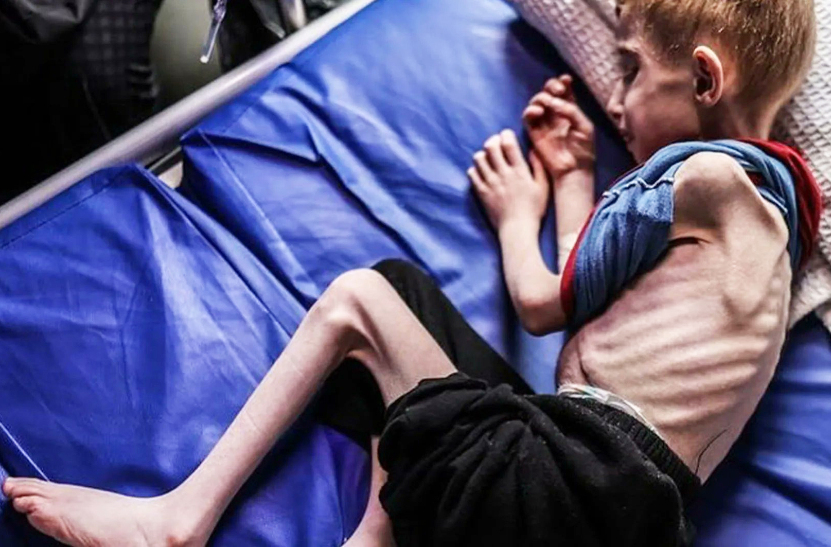 Tình cảnh trẻ em Palestine ở Gaza khi cả chục ngàn ca suy dinh dưỡng cấp tính