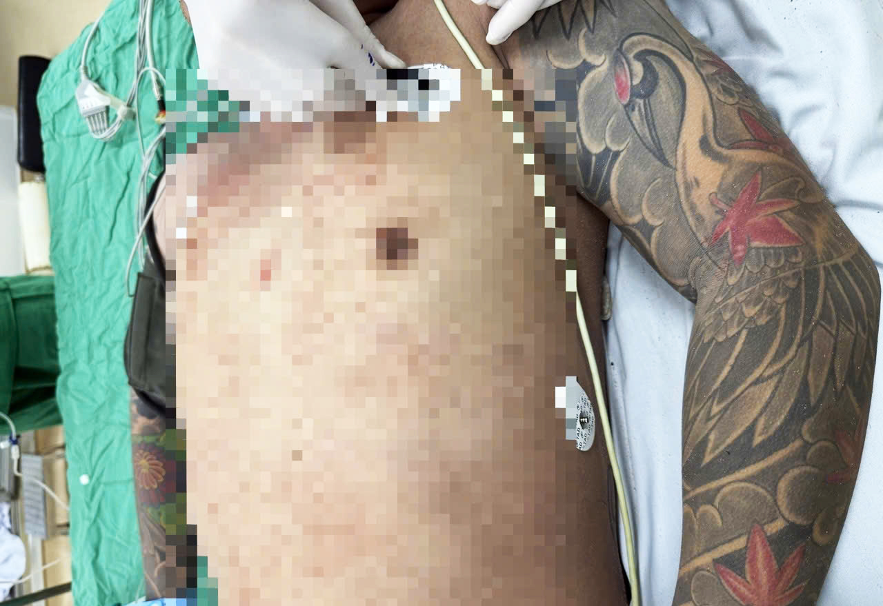 Cứu sống bệnh nhân nguy kịch với vết thương thấu ngực, thủng tim